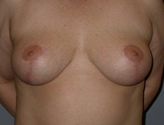 Patient # 82406 After Photo # 2